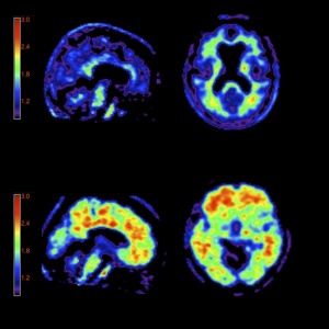 Imagens de um cérebro saudável, acima, e de um paciente com Alzheimer, abaixo, com placas em vermelho