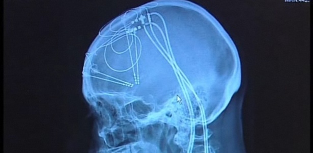 A técnica, chamada de estimulação cerebral profunda, envolve o uso de fios e eletrodos implantados no cérebro por meio de furos abertos no crânio