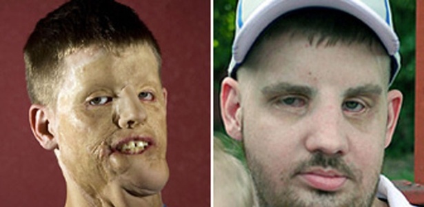 Antes e depois do ex-soldado Mitch Hunter