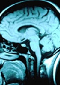 Especialistas querem descobrir mudanças iniciais no cérebro que indiquem Alzheimer