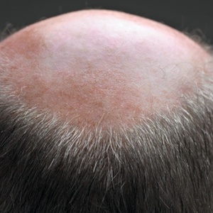 A análise desses resultados indicou que o risco de doença coronária é maior quanto mais severa for a calvície, mas apenas se a falta de cabelo afetar o topo da cabeça, e não a região acima da testa - Getty Images